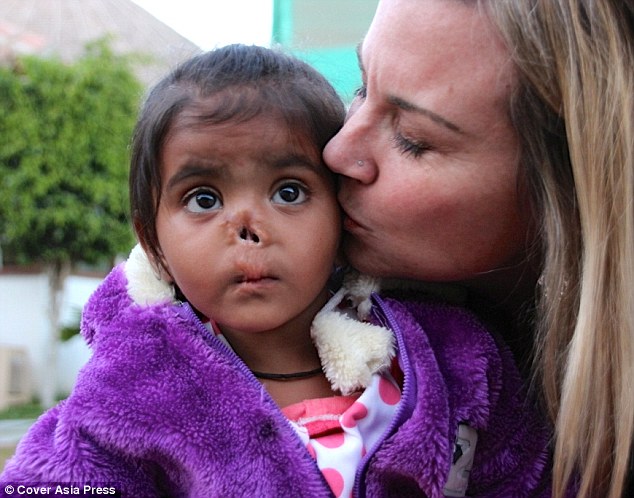 Kristen Williams, a teacher from Ohio, adopted little Durga who was abandoned at work causing her nose to be eaten by insects