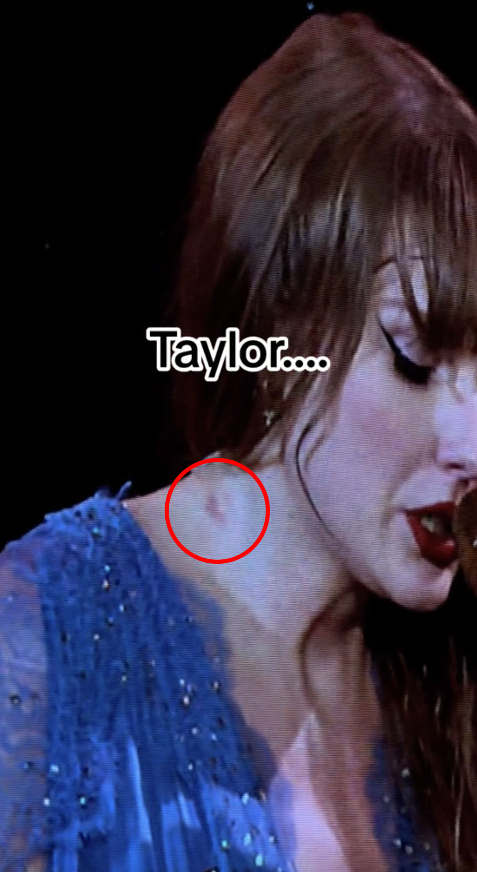 Taylor Swift fans noticed a mark on the music icon's neck during her Eras tour in Sweden over the weekend